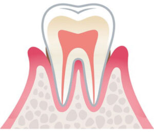 歯周病の進行 軽度