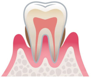 歯周病の進行 中等度