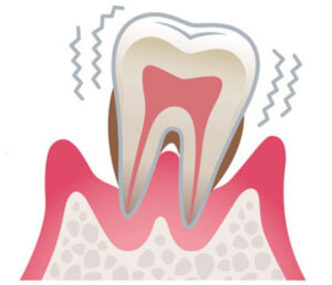 歯周病の進行 重度